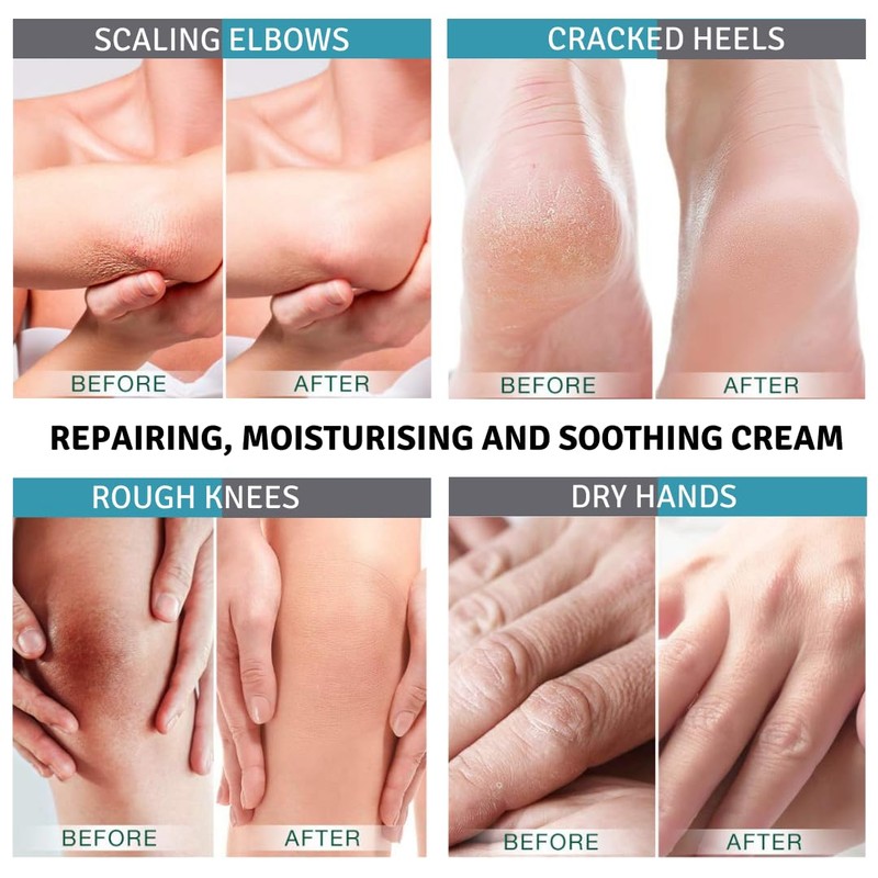 GliceroTIS Cream 50 g - Scars, Keratosis, Psoriasis, Relieving, Moisturising,