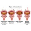 Bladder Regulator, Gosha Jinki Gan. an Effective Herbal Bladder Control