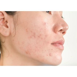 A3 Lemon Face Gel | For Oily Skin | 25ml