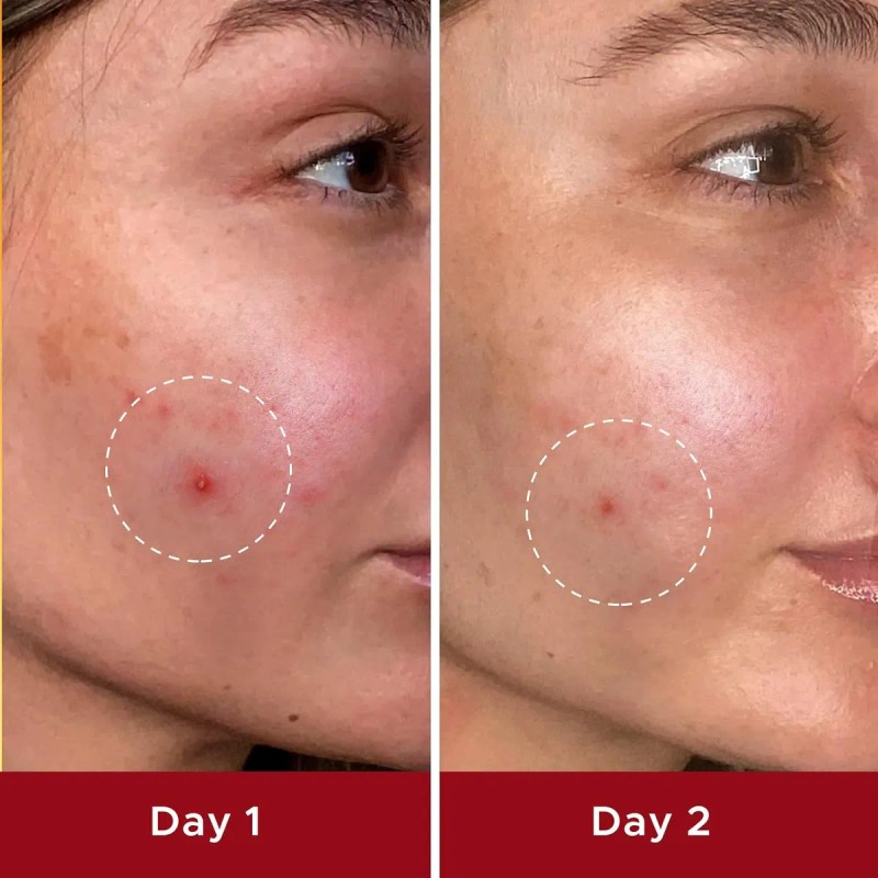 Parches De Espinilla De Difamación, Parche De Cubierta De Ac