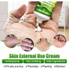 Crema Natural A Base De Hierbas Antipicazón, Crema Para Psoriasis