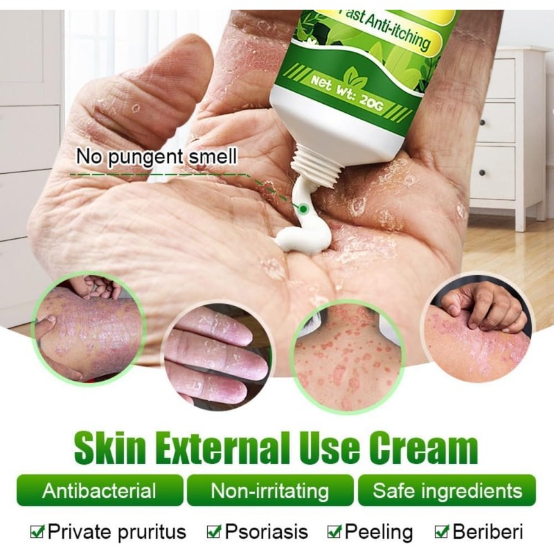 Crema Natural A Base De Hierbas Antipicazón, Crema Para Psoriasis
