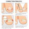 Ingrown Toenail Pedicure Tool 10pcs/bottle Straightening Clip Curved BS Brace