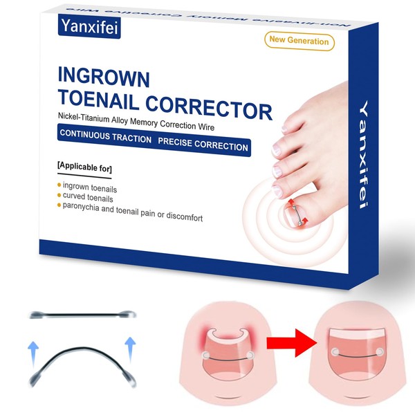 Nitinol Ingrown Toenail Corrector,at Home Ingrown Toenail Treatment,Curved Toenail Straightener,Ingrown