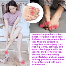 Qvlaitoe Hammer Toe Straightener, Hammer Toe Corrector for Women, 6 Pack Toe Straighteners for Curled, Crooked Toes, Medium Size, Beige
