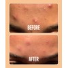 Absorbzit - The Everyday Hydrocolloid Pimple Patches, Ultra Thin Spot
