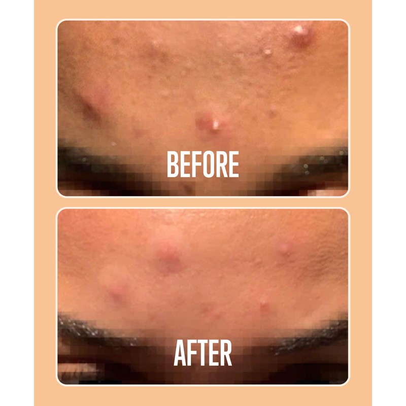 Absorbzit - The Everyday Hydrocolloid Pimple Patches, Ultra Thin Spot