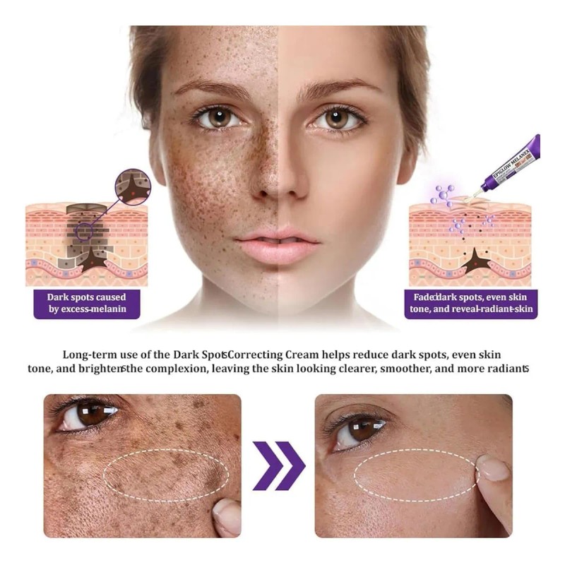 Crema Epiglow Melanex Advanced Anti-hiperpigmentación