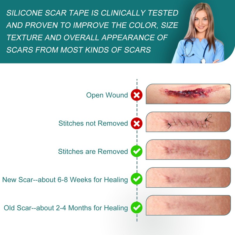 Silicone Scar Sheets (1.6"x 158" Roll-4M), Silicone Scar Tape for