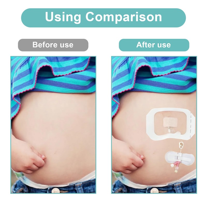 Catheter Stabilization Device,Feeding Tube Holder,Self Adhesive Catheter Holder Patch Dressing