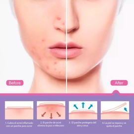 UNIVERSOENLÍNEA.C0M 48 Parches Acne Dia/Noche Invisibles, Remueve y tapa el Acne, Espinillas, puntos negros, diferentes tamaños, previenen manchas faciales