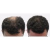 Blackbeard Scalpixyl 10% Crecimiento Anticaída Cabello 30 Ml