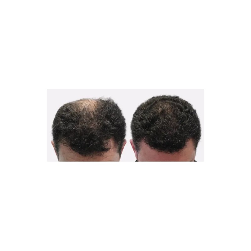 Blackbeard Scalpixyl 10% Crecimiento Anticaída Cabello 30 Ml