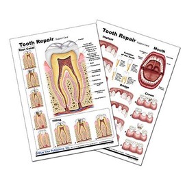 Tooth Repair Poster, Chart (Laminated Card, A4)