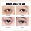 B Aclarar Ojeras, Bolsas Debajo De Los Ojos, Elásticas,