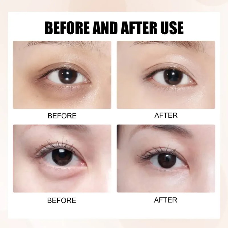 B Aclarar Ojeras, Bolsas Debajo De Los Ojos, Elásticas,