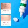 Crema De Ácido Salicílico Para El Control Del Acné Para