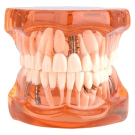 FTVOGUE Enfermedad Dental de Color Naranja Estudio de demostración extraíble Modelo de Dientes de enseñanza para Dentista y Escuela