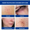 Crema Para El Tratamiento De La Foliculitis Y El Acné