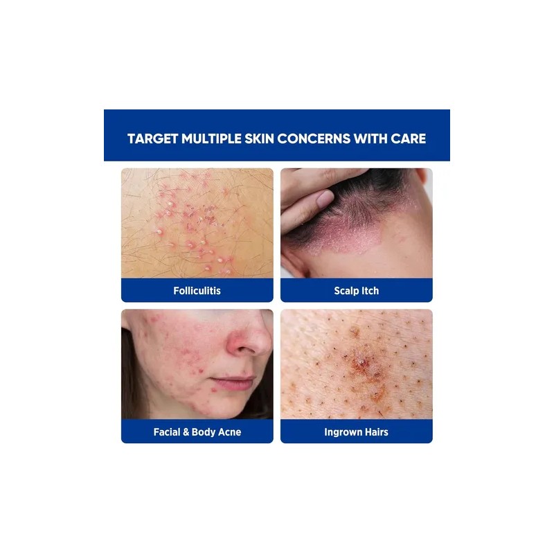 Crema Para El Tratamiento De La Foliculitis Y El Acné