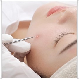 제거기 압출기 피지 제거용 핀셋으로 흉터없이 깨끗하게 제거 Extractor Pore Extractor Tweezers for Clean Removal Without Scars