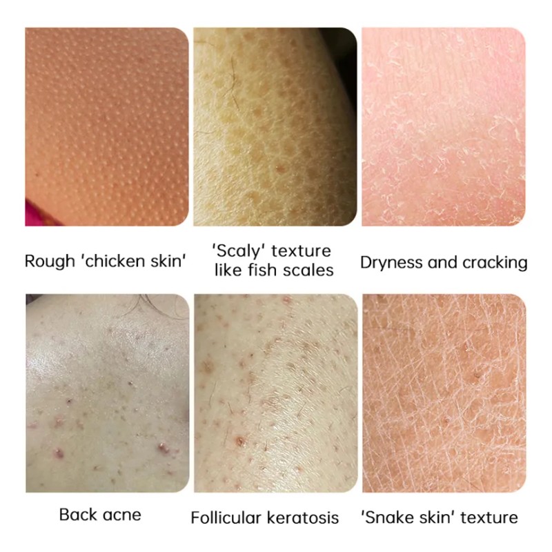 Crema Blanqueadora Para Tratar La Queratosis Corporal Con Pr