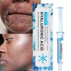 Acido Hialuronico Facial, Antiedad, Manchas, Acne 5pzs