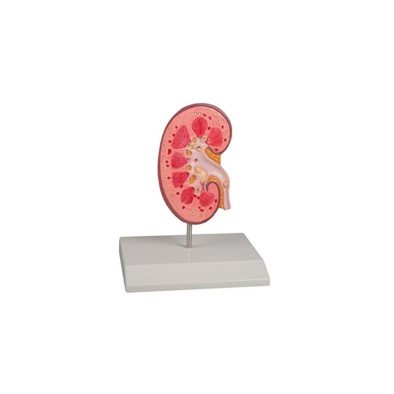 Kidney stone model