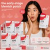 Umeva Acne Patch Hydrocolloid Pimple Patches (72 Count)