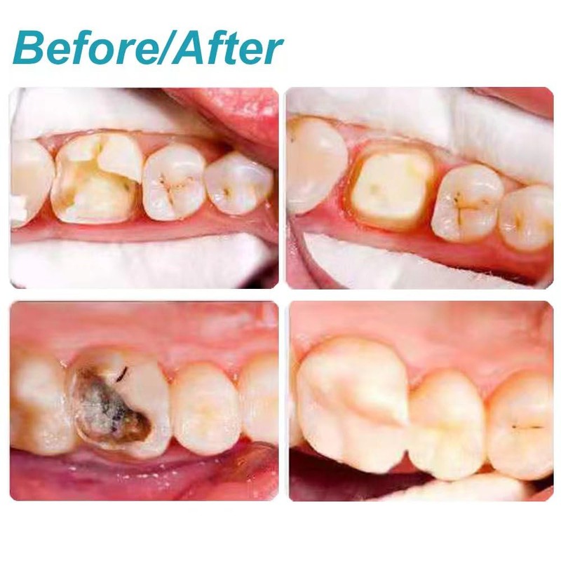 Broken Tooth Repair Kit-Temporary Teeth Replacement Kit for Fixing Filling