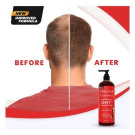 Dht Blocker Champú Anti-pérdida De Cabello Con Biotina
