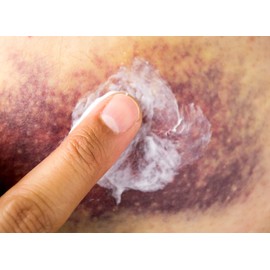 Arnica Bruise Cream Arnica Oil for Bruising Arnica Massage Oil Arnica Massage Balm Made in Yorkshire (250ml Oil)