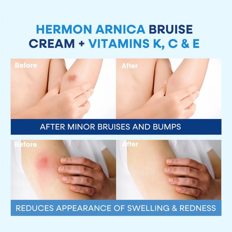 Hermon Arnica Bruise Cream Extra Strength: Fast-Acting for Bruising &