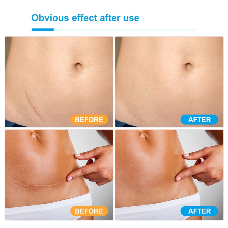 Adhesive Silicone Scar Patch Safety Mild Fade Scar Scar Reduction