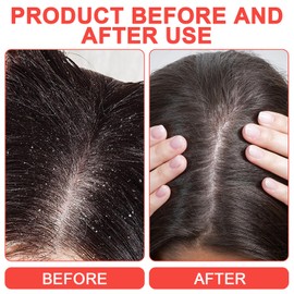 2PCS Dandruff Comb,Flea Comb for Dogs,Scalp Comb, Stainless Steel Fine High Strength Teeth Combs,Professional Wide Tooth Comb Scalp Care Tool,for Dogs and Cats,Comes with 2 Double-Sided Combs