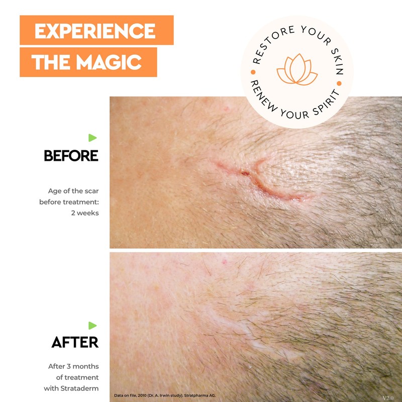 Strataderm Professional Scar Therapy Gel | Old and New Scars