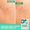 Face Invaders Acne Patches | Pack of 108 Translucent Hydrocolloid