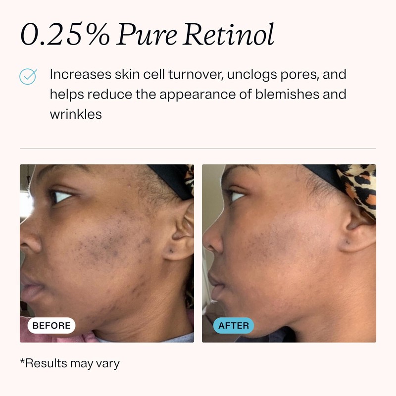MDacne Retinol 2.5% and Niacinamide 2% Cream (3-pack), Reduces Blemishes