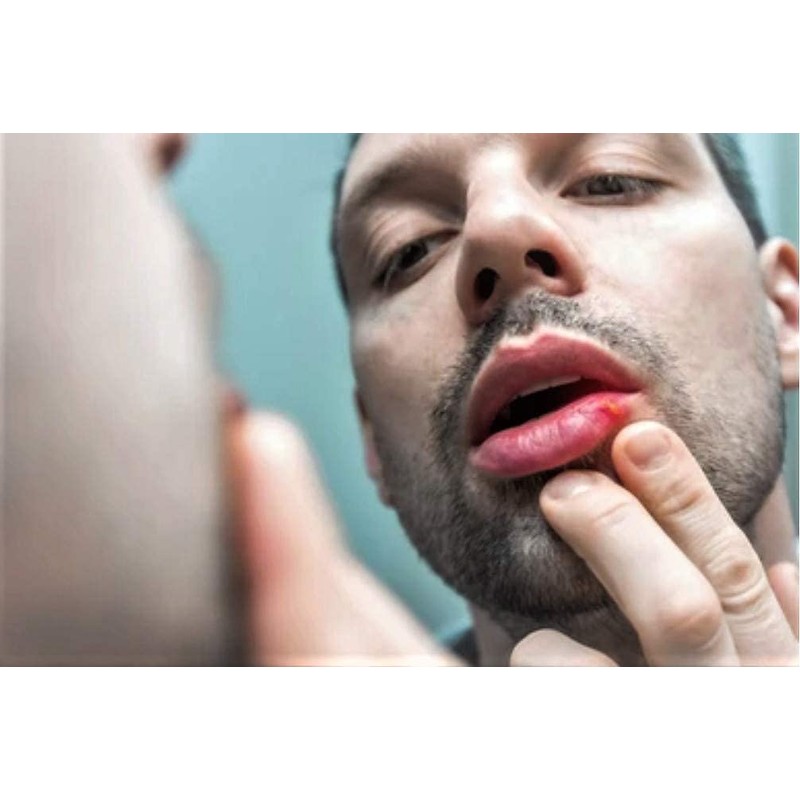 CS Lip Oil - famed for cold sore relief