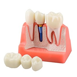 Ultrassist Modelo de implante dental para educación del paciente, implante dental 4 veces, modelo de corona y puente para presentación-rosa