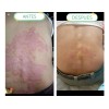 Crema Psoriasis