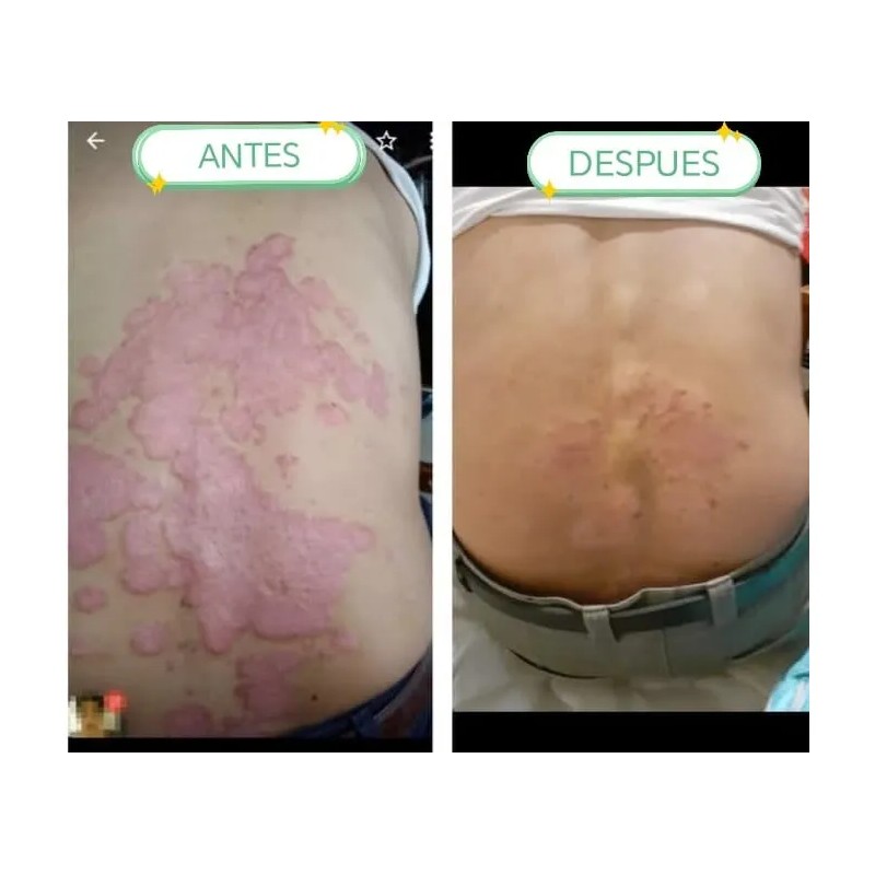 Crema Psoriasis