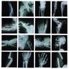 16Pcs Realistic Broken Bones X-Ray (9.8"x9.8") Skeleton X-Rays Human Skeleton
