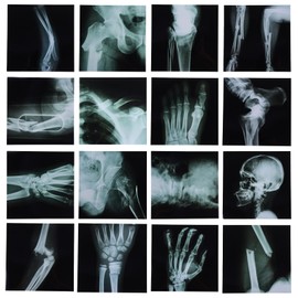 16Pcs Realistic Broken Bones X-Ray (9.8"x9.8") Skeleton X-Rays Human Skeleton Broken Bones PVC Plastic X-Ray Pretend Play Doctor Kit Learning Toy for Role-Playing Homeschooling School Supplies