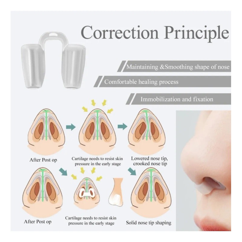 Kit Férula Doyle Nasales Médica Termoplásticas Rinoplastia Transparente