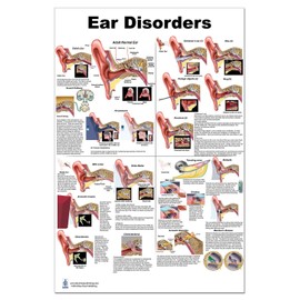 Blue Tree Publishing Ear Disorders Poster 24x36inch, Otitis and Other Disorders