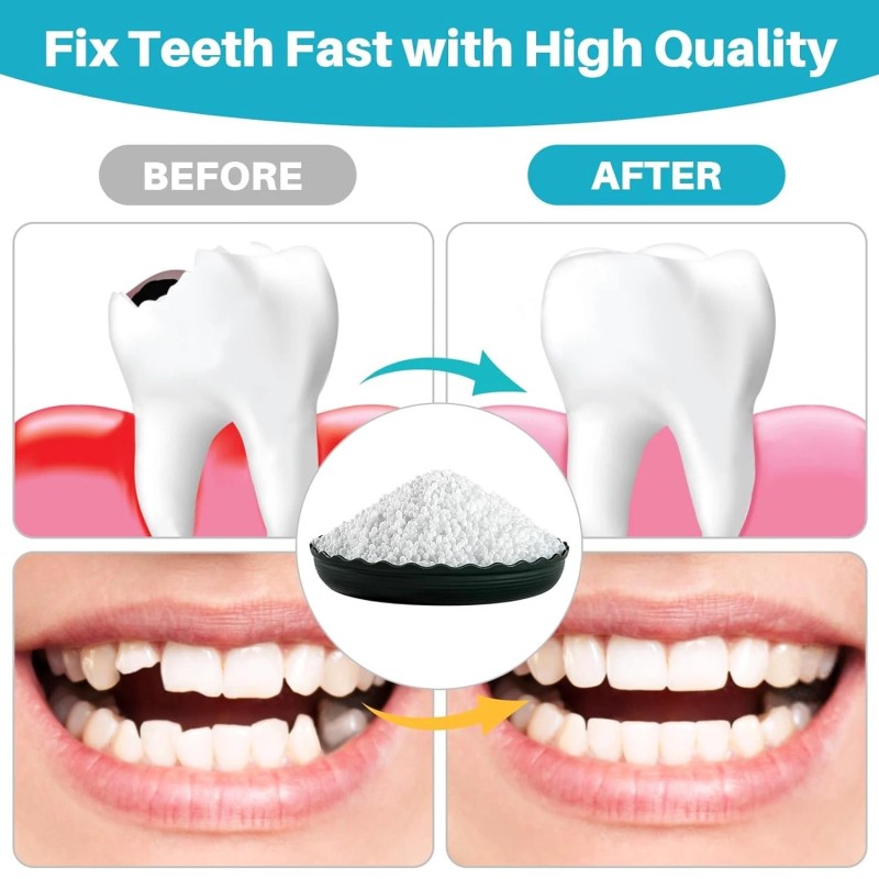 Sukh 10.9oz Moldable False Teeth Beads - Tooth Repair Kit,Repair