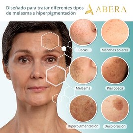 Abera Melasma Sérum, Suero Facial Despigmentante, Tratamiento para Melasma y Manchas Oscuras, con Niacinamida, Genowhite y Baba de Caracol,...        