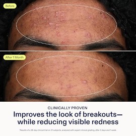 Skinfix- Gel Acne+ Adapinoid®: Renueva y limpia la piel propensa al acné sin irritarla y manteniendo la cicatrización.