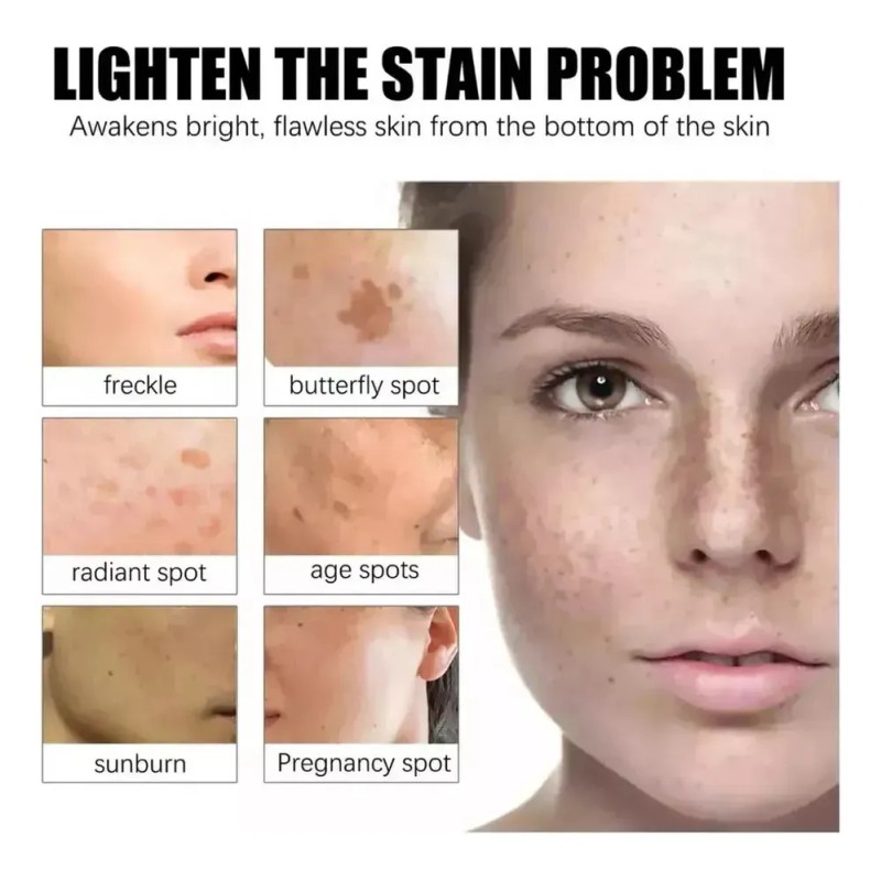 Crema Betarretin Manchas